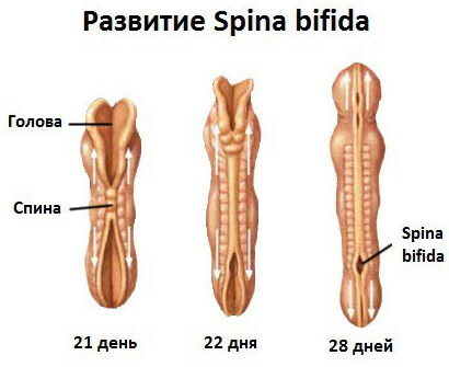 Spina bifida S1 in adults. Treatment, what does it mean