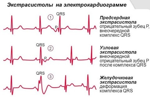 A szív extraszisztoléja. Okok, tünetek, kezelés felnőtteknél, gyermekeknél