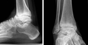 feet on X-ray
