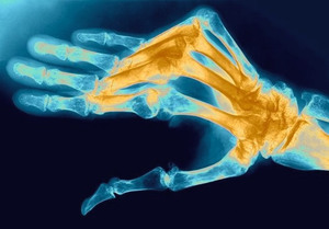 Vingers van handen, artritis