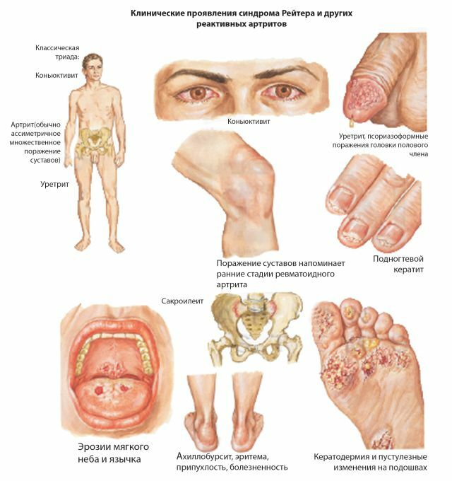 Sintomas da artrite clamidial