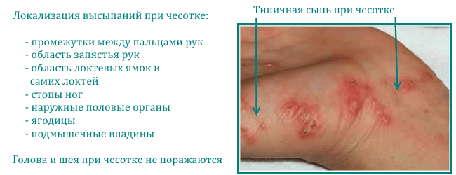 Localization of rashes with scabies