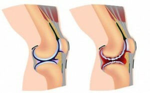 osteoporose van het kniegewricht