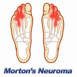 Neuroma Morton