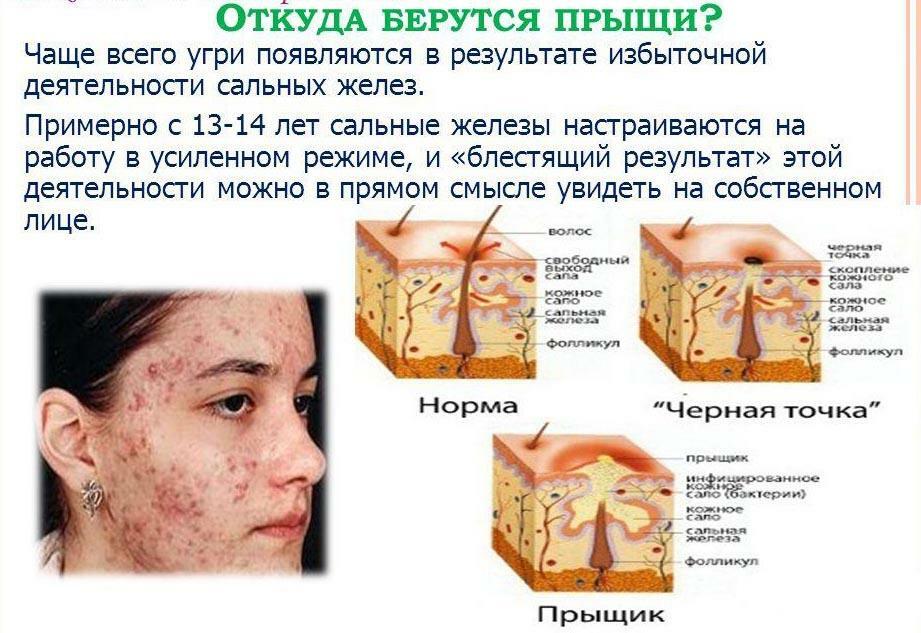 Formazione di acne