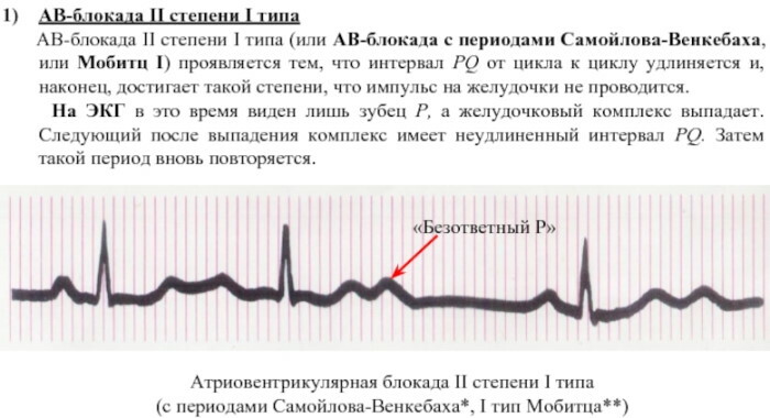 Frederick's syndrome on the ECG. What are these, signs, reasons