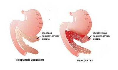 Dor no estômago( aguda, dolorida, áspera, aborrecida): causas, sintomas, tratamento