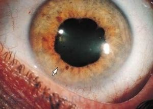 retrobulbar neuritis of the optic nerve