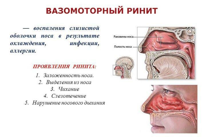 Signs of vasomotor rhinitis