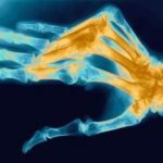 polyarthritis van vingers