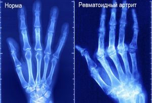 revmatoidní artritida