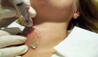 Treatment of thyroid cyst