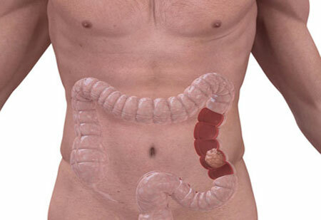 Cáncer de intestino: signos y síntomas en etapas, pronóstico de tratamiento del cáncer
