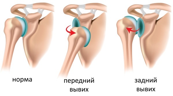 Dislocation of the shoulder joint. Treatment, rehabilitation, exercise, symptoms, first aid, x-ray