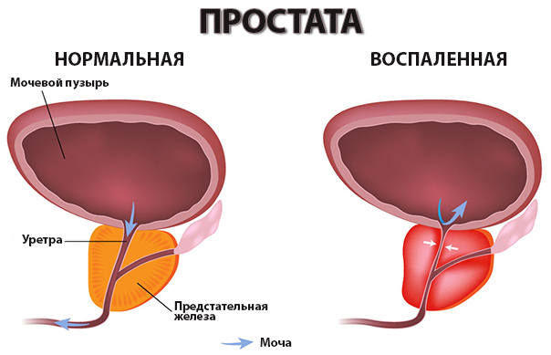 What is the difference between prostatitis and prostate adenoma?