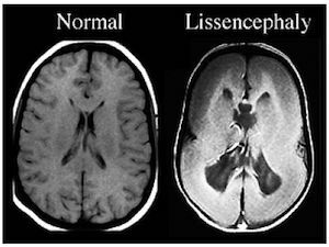 malformații și creier normal