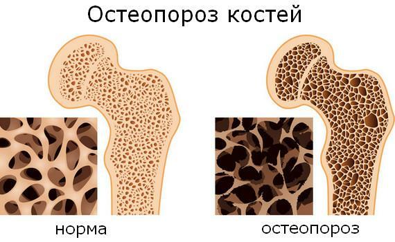 Osteoporose von Knochen