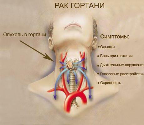 Symptoms of laryngeal cancer