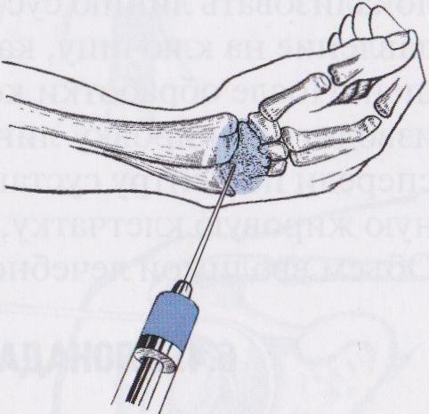 Puncția articulației încheieturii mâinii