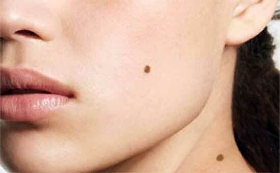 How to remove a birthmark at home