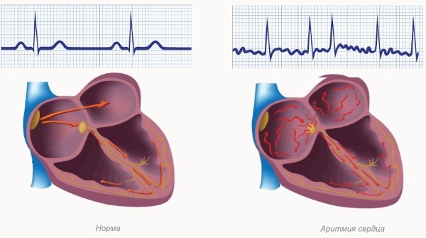 Cardiac arrhythmia: atrial, ventricular, paroxysmal. First aid, symptoms and treatment: pills, folk remedies