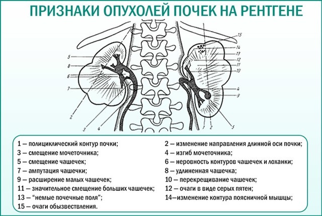 Excretory urography. Preparation of the patient, how is it done, contraindications