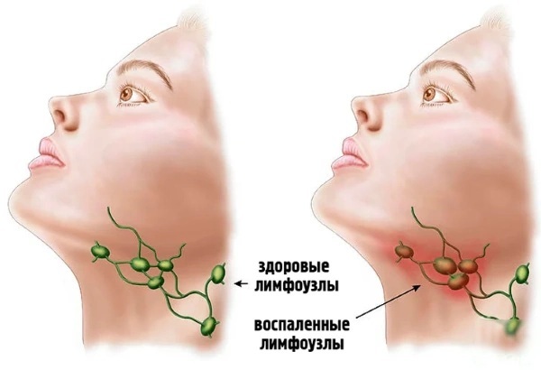 Lymphadenitis on the neck. Causes, symptoms, treatment, antibiotics, ointments