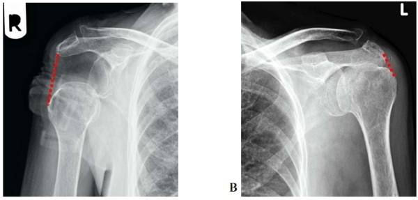 Dislocation of the shoulder joint. Treatment, rehabilitation, exercise, symptoms, first aid, x-ray