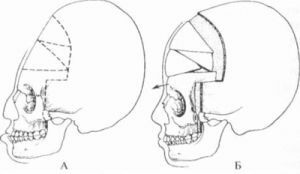 crânio antes e depois da cirurgia