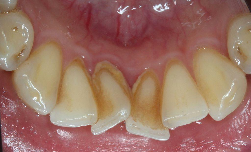 Gigitan yang salah menyebabkan perkembangan karies, periodontitis dan penyakit gigi dan gusi lainnya