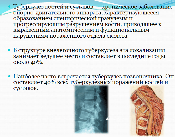 Tuberculose des os et des articulations