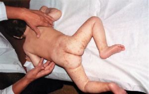 skleroosi tuberous lapsilla