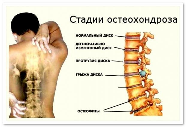 Stadien der Osteochondrose