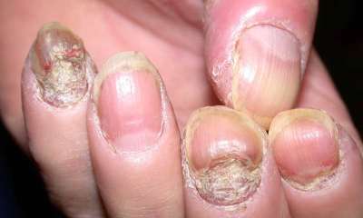 Psoriasis av naglar och fingrar