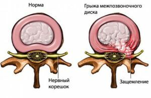 Hernia intervertebrală