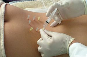 Micropharmacopuncture