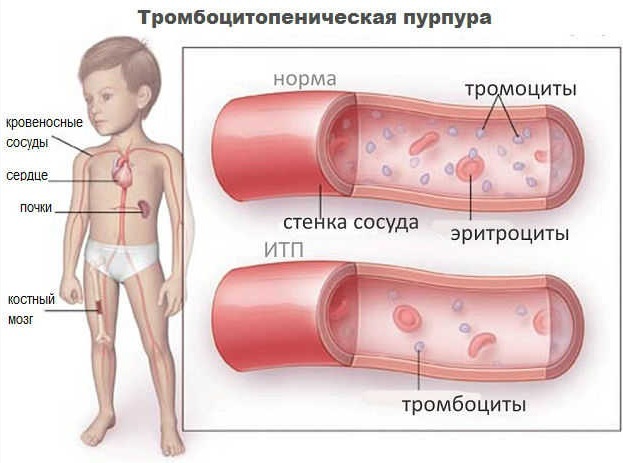 Purpura thrombocytopénique idiopathique (PTI). Traitement, diagnostic, classification