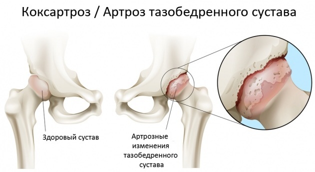 Ejercicios para las articulaciones de la cadera con coxartrosis, artrosis, dolor según Bubnovsky, Evdokimenko. Video