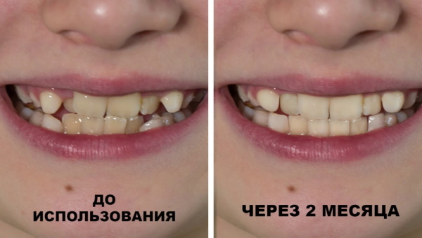 Štitnici za usne za ravnanje zuba za djecu, odrasle. Cijena, prednosti i nedostaci