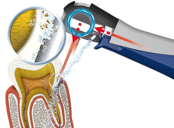 Dispositivo de vetor para o tratamento de periodontite, gengivas, limpeza de dentes em odontologia. O que é isso