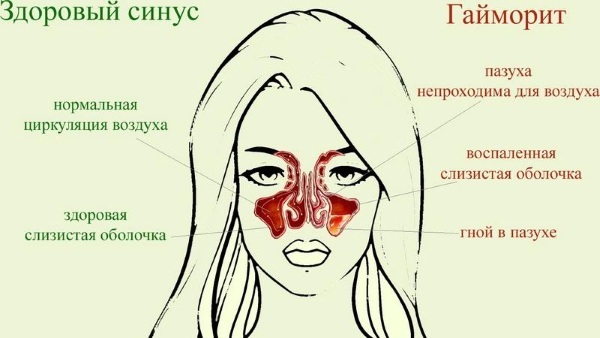 L'unguento di Simanovsky per il naso. Istruzioni per l'uso, recensioni