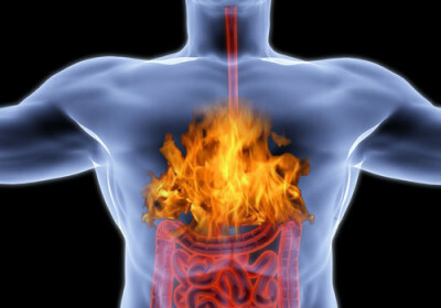 Gastroesophageal reflux disease( GERD): what is it, symptoms, causes, treatment