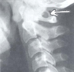 anomaly of the first cervical vertebra