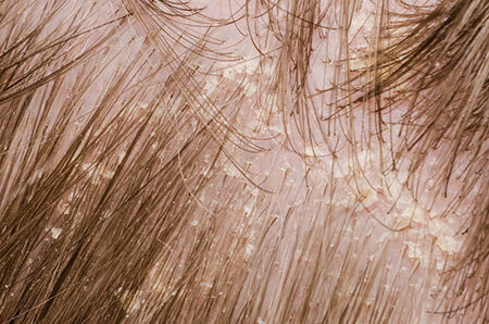 O estágio inicial da dermatite seborreica no couro cabeludo, foto 3