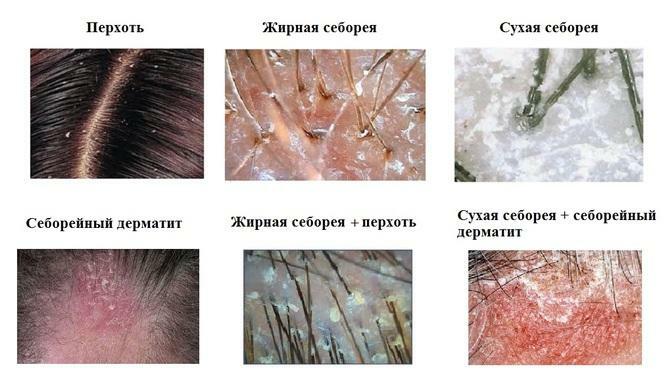 Types of seborrhea