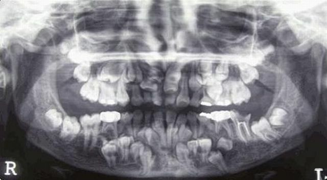 Série dentária de paciente com disostose