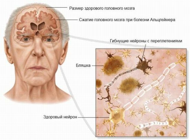 brain damage in Alzheimer