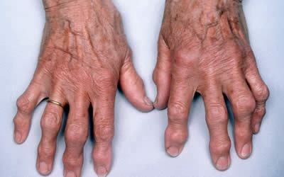 Osteoartrita mâinilor