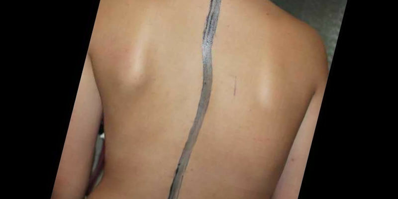 Symptoms and treatment of stage 1 scoliosis