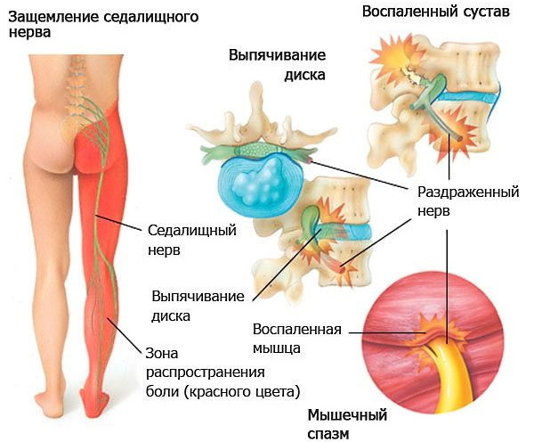 Sidal nerve. Treatment with folk remedies, gymnastics, medicines